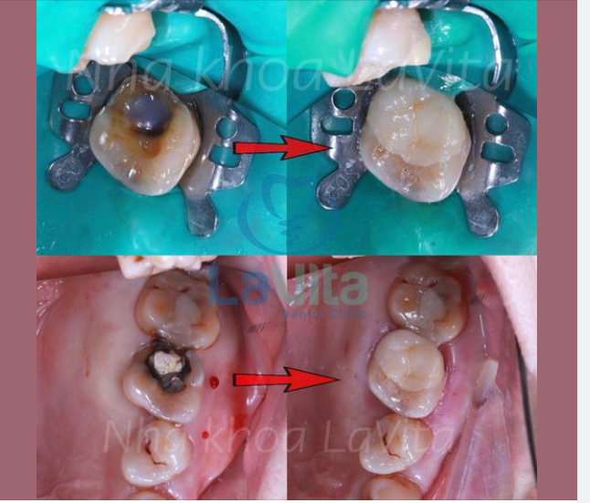 Tuy nhiên, đó không phải là giải pháp duy nhất cho tình trạng của bạn, mà Inlay, Onlay cũng hoàn toàn có thể đáp ứng được một cách hoàn hảo.