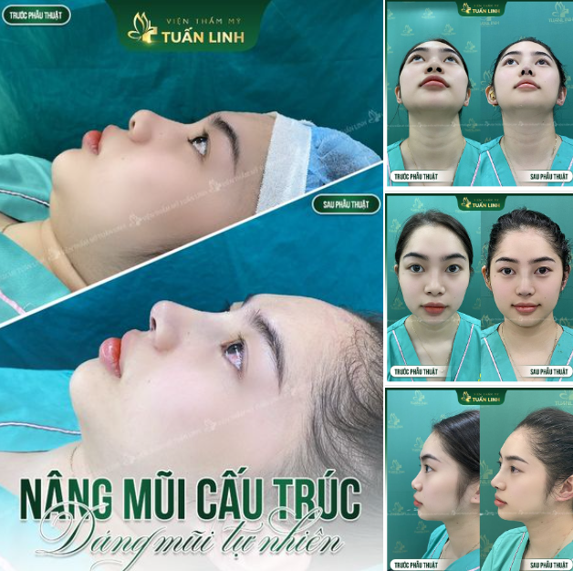 Nâng mũi cấu trúc chỉ 2X triệu - Mũi đẹp tự nhiên ngay sau 90 phút phẫu thuật.