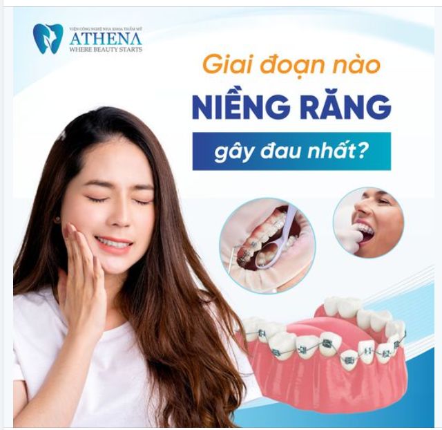 NIỀNG RĂNG ĐAU NHẤT LÀ LÚC NÀO?
