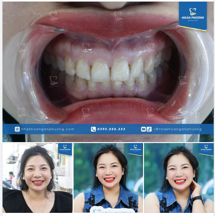 Răng nhiễm màu nặng, muốn khắc phục hoàn toàn thì phải làm sao?