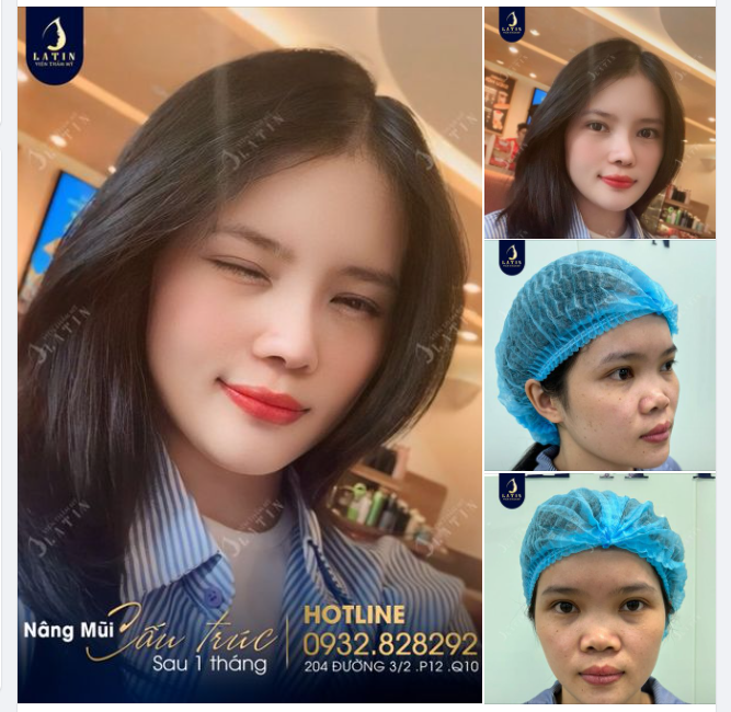 Nâng mũi thay đổi nhiều không?