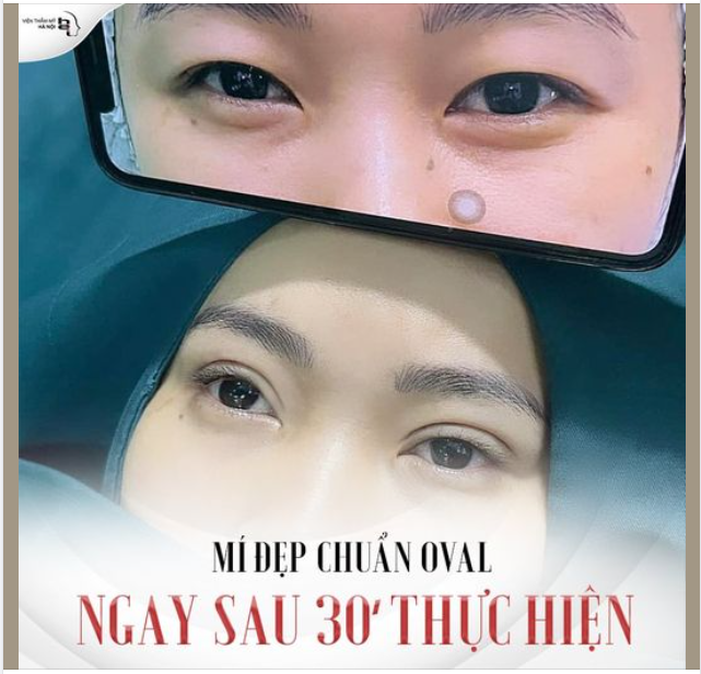 30P thực hiện chia tay tình trạng mí lệch, sụp mí, nhiều nếp mí  Chọn ngay nhấn mí Oval Line Wide Deep.