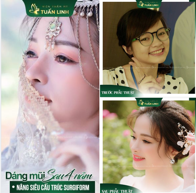 REVIEW DÁNG MŨI SAU 4 NĂM SẼ TRÔNG NHƯ THẾ NÀO??