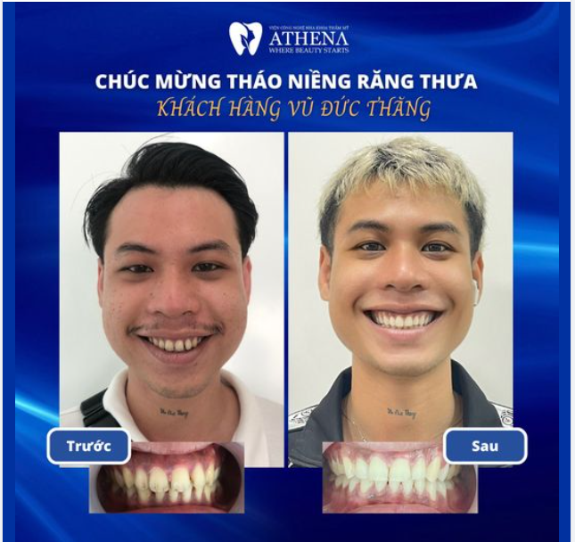 RĂNG THƯA HỞ KẼ - CƯỜI KHẼ CŨNG KHÔNG TỰ TIN