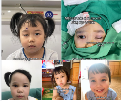 Hành trình điều trị sụp mí bẩm sinh của bé gái 4 tuổi tại Dr. Minh Phạm