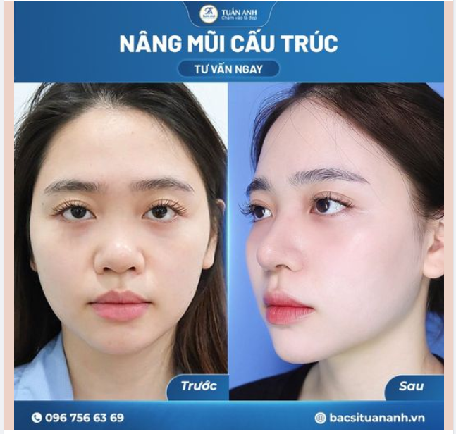 NÂNG MŨI CẤU TRÚC – KIẾN TẠO SỐNG MŨI THANH TÚ