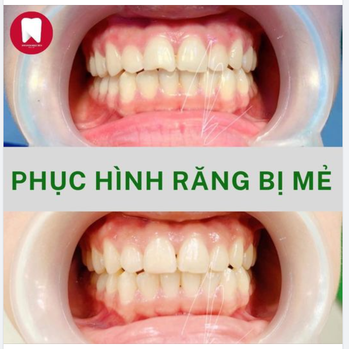 RĂNG VỠ LẠI LÀNH NHỜ PHƯƠNG PHÁP TRÁM RĂNG THẨM MỸ