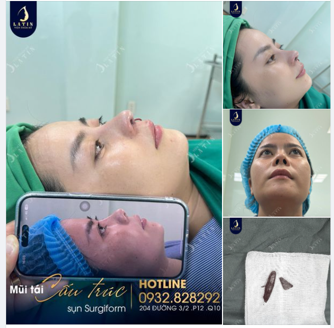 Mời cả nhà cùng xem kết quả mũi tái cấu trúc, sóng surgiform mà Latin đã thực hiện cho chị L.H sau 2 tiếng nhé!