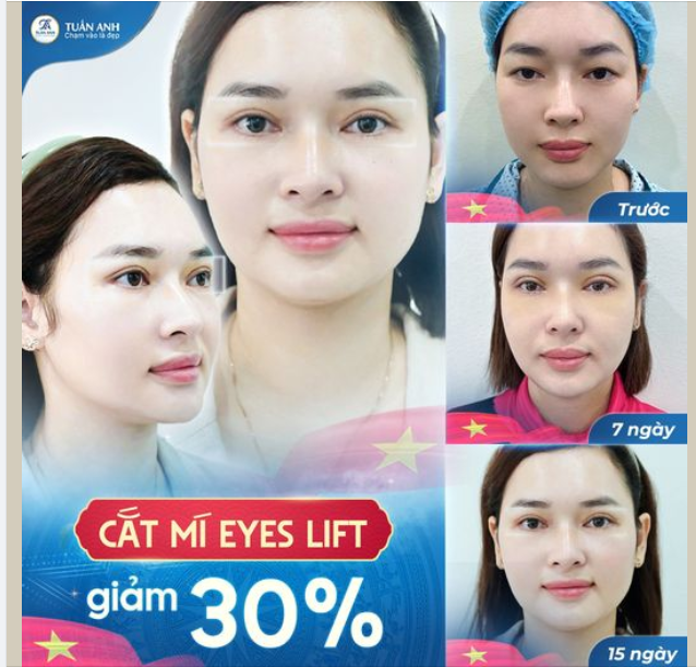 ƯU ĐÃI ĐẠI LỄ - THẨM MỸ VÙNG MẮT