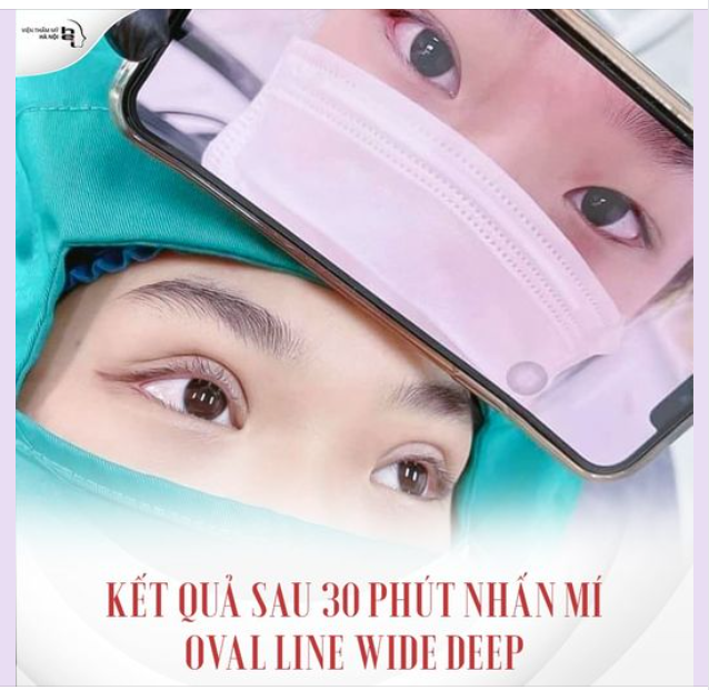 Mời cả nhà cùng chiêm ngưỡng kết quả ngay sau 30P thực hiện nhấn mí Oval Line Wide Deep tại VTMHN