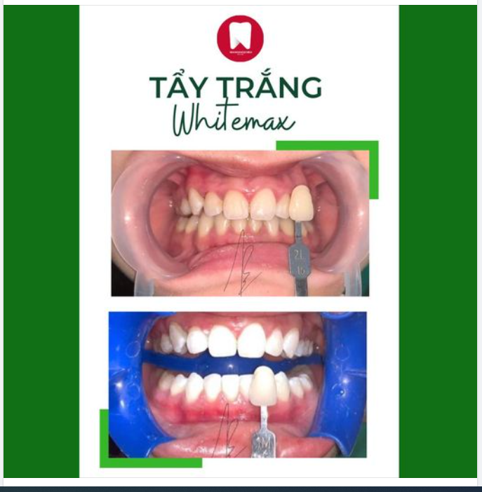 THAY MÀU ÁO CHO HÀM RĂNG BẰNG PHƯƠNG PHÁP TẨY TRẮNG RĂNG TẠI NHA KHOA NGỌC BÍCH