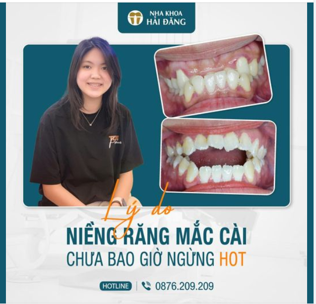 Niềng răng kim loại giờ đang hót nhất hiện nay, mà các ba mẹ đang quan tâm & chăm sóc cho con ngay từ khi còn nhỏ.