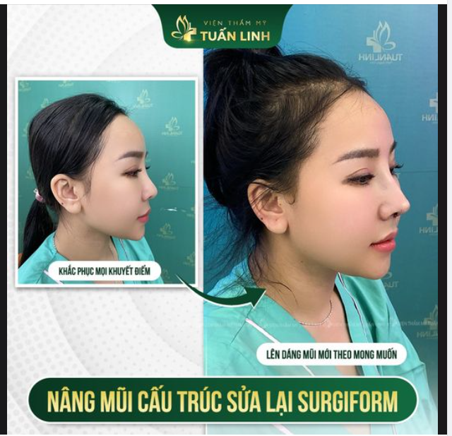 Khắc phục tình trạng đầu mũi ngắn hếch, sống mũi thấp, mũi đã qua phẫu thuật da mũi mỏng ít... cho bạn gái đến từ TP HCM.