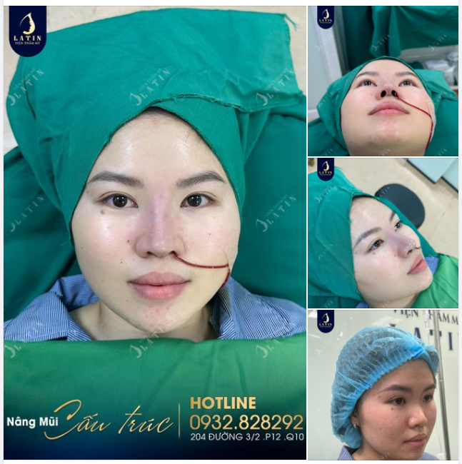 Em gái đến từ Sóc Trăng sau khi nâng mũi cấu trúc, lót megaderm