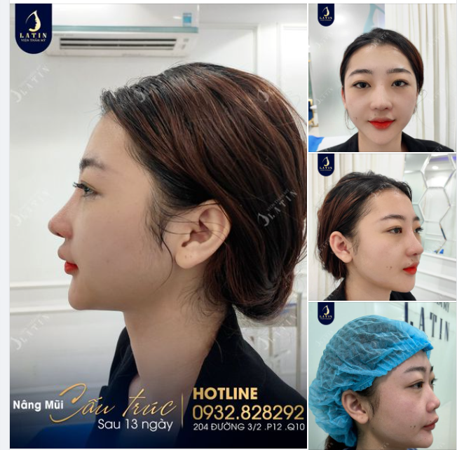 Dáng mũi mới 13 ngày của khách nhà Latin. Em gái tái khám sau 13 ngày nâng mũi cấu trúc với tâm trạng tự tin và hạnh phúc
