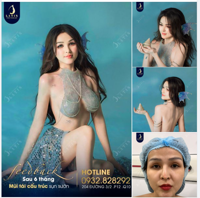 Chị gái tìm lại tự tin sau 6 tháng tái tạo dáng mũi mới