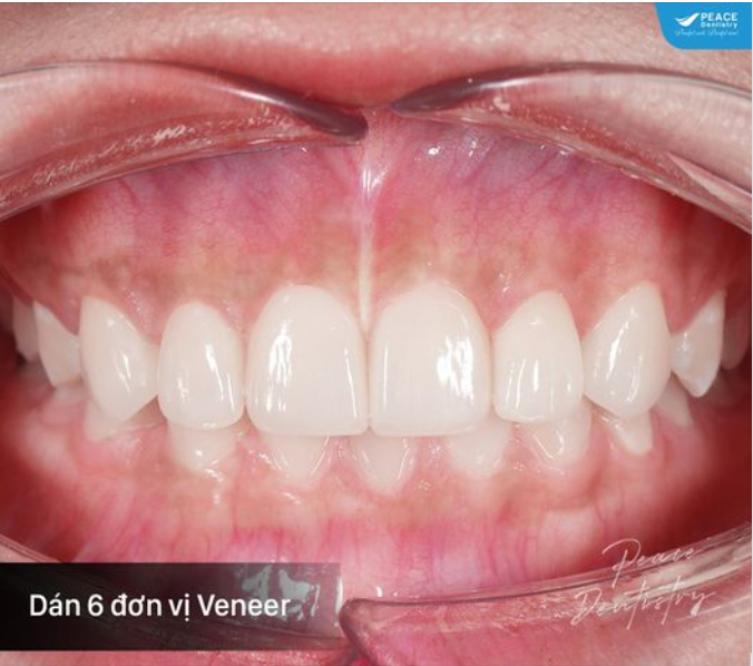 Hình ảnh ca lâm sàng tại Peace Dentistry thay đổi nụ cười ấn tượng chỉ với 6 mặt sứ Veneer IPS e.max cho vùng răng cửa trước.