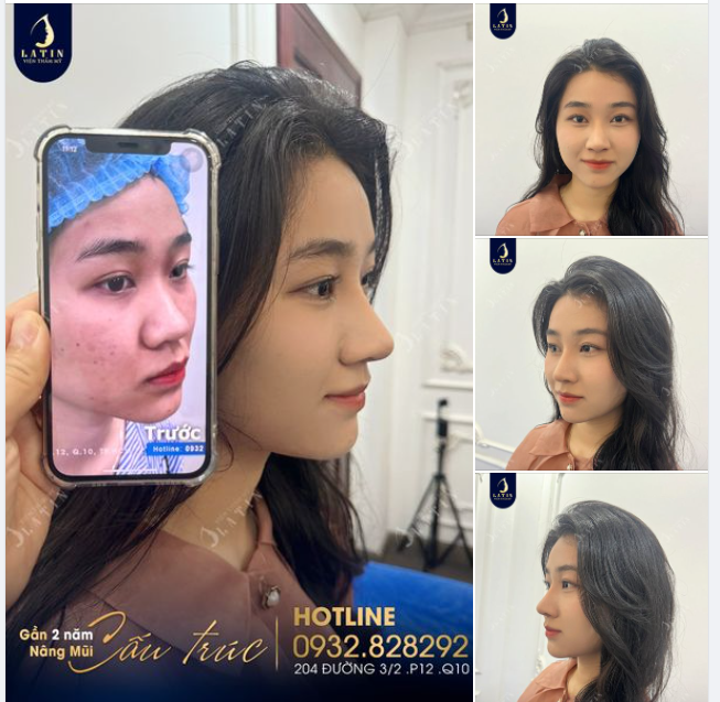 Nét đẹp "nàng thơ" của khách yêu nhà Latin sau 2 năm nâng mũi cấu trúc
