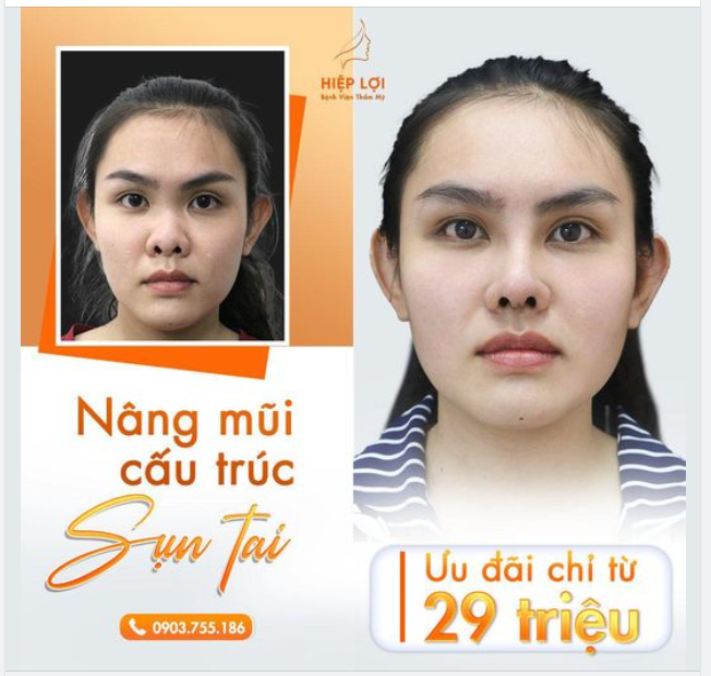NÂNG MŨI CẤU TRÚC SỤN TAI - CHỈ TỪ 29TR