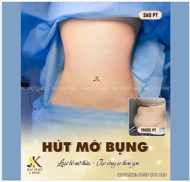 HÚT MỠ BỤNG - LOẠI BỎ MỠ THỪA - TẠO VÒNG EO THON