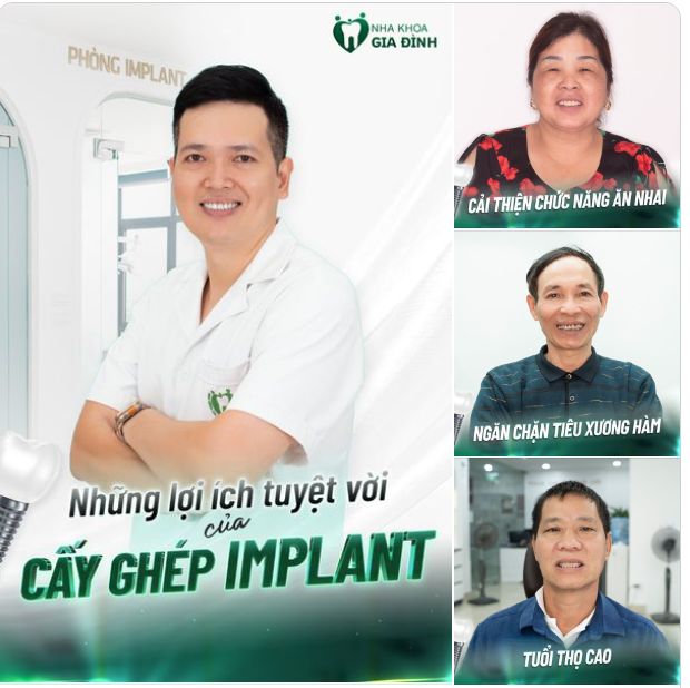 NHỮNG LỢI ÍCH TUYỆT VỜI CỦA TRỒNG RĂNG IMPLANT