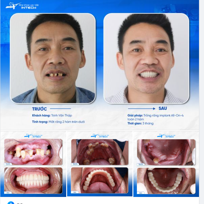TỪ BẮC NINH LÊN HÀ NỘI TRỒNG RĂNG THAY ĐỔI NGOẠN MỤC 3 THÁNG