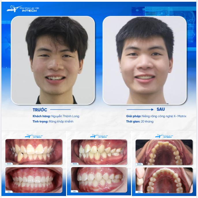 HẾT KHẤP KHỂNH MÀ KHÔNG CẦN NHỔ RĂNG NHỜ CÔNG NGHỆ X-MATRIX, CHÀNG TRAI LỘT XÁC HOÀN TOÀN