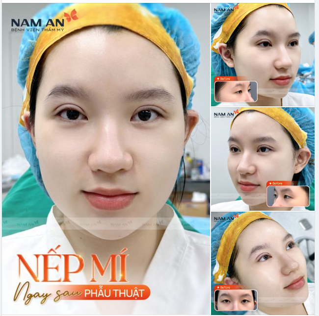 ĐÔI MẮT XINH ĐẸP SAU CẮT MÍ