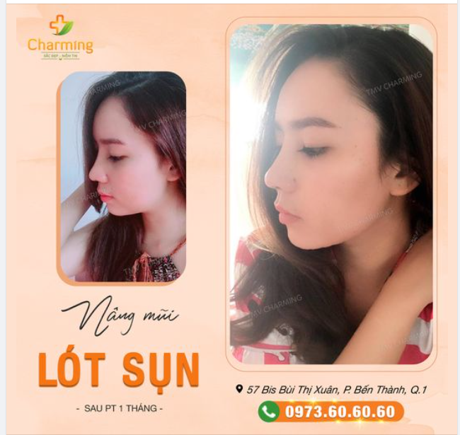 Nàng khách gửi hình feedback chiếc mũi lót sụn cho Charming kèm với lời nhắn "ưng quá chừng" khiến cho Charming cảm thấy tưng bừng cả ngày luôn