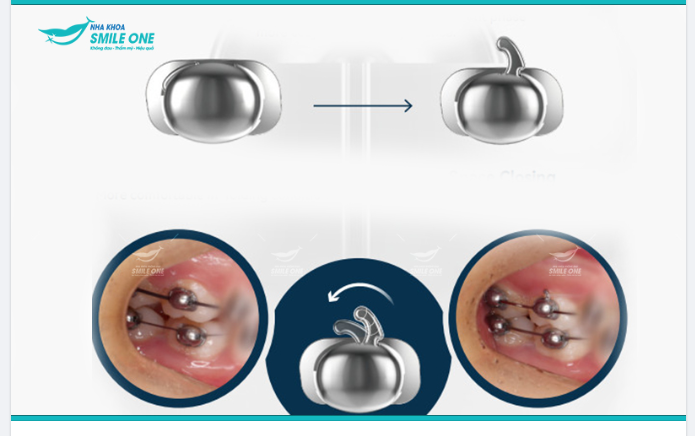 MẮC CÀI CÁNH CAM, ĐỘT PHÁ TRONG CÔNG NGHỆ NIỀNG RĂNG MẮC CÀI THẾ HỆ MỚI