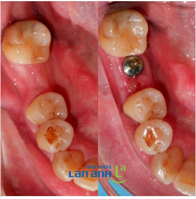 Hình ảnh khách hàng tái khám đặt Implant sau 4 tháng nhổ răng tại chi nhánh 292 Huỳnh Văn Bánh, P11, Q. Phú Nhuận