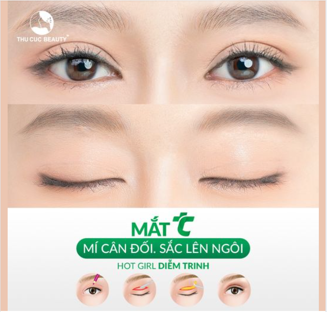 KH Diễm Trinh sau cắt mí