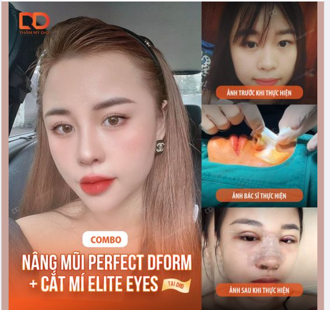 Feedback siêu xinh của khách hàng thực hiện combo cắt mí +nâng mũi tại Thẩm mỹ DrD