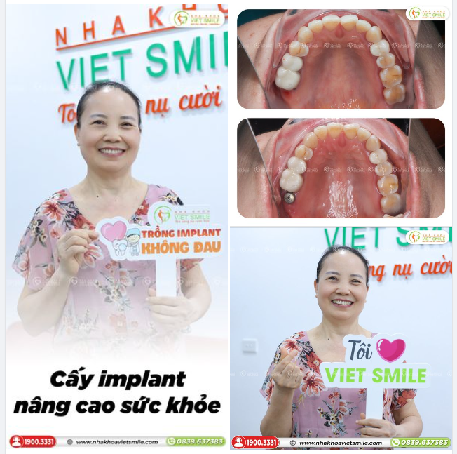 CẤY IMPLANT KHÔI PHỤC LẠI RĂNG 7 ĐÃ MẤT