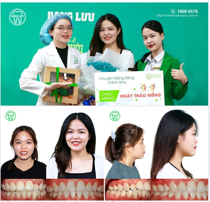 RĂNG XINH RỒI, NIỀNG-ER HÃY CƯỜI NHIỀU HƠN NỮA NHÉ!