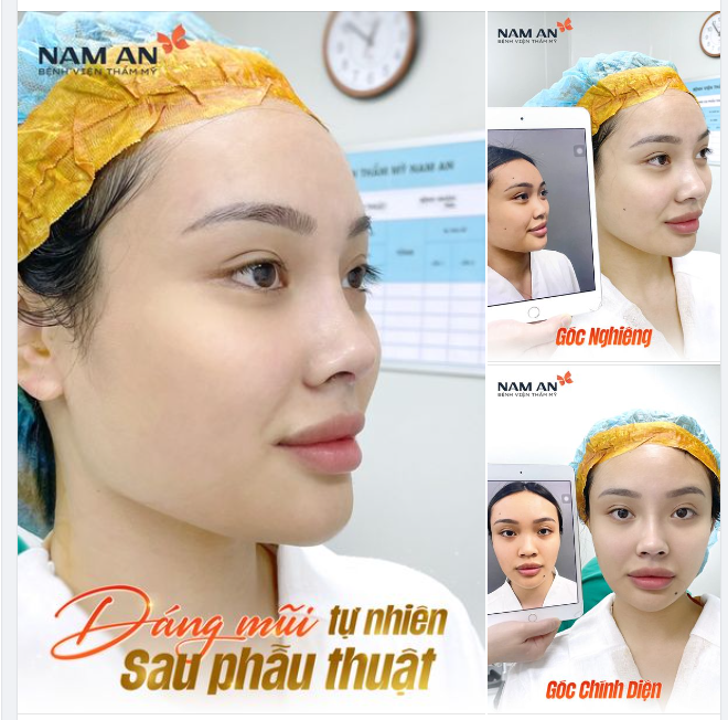 DÁNG MŨI TỰ NHIÊN NGAY SAU PHẪU THUẬT