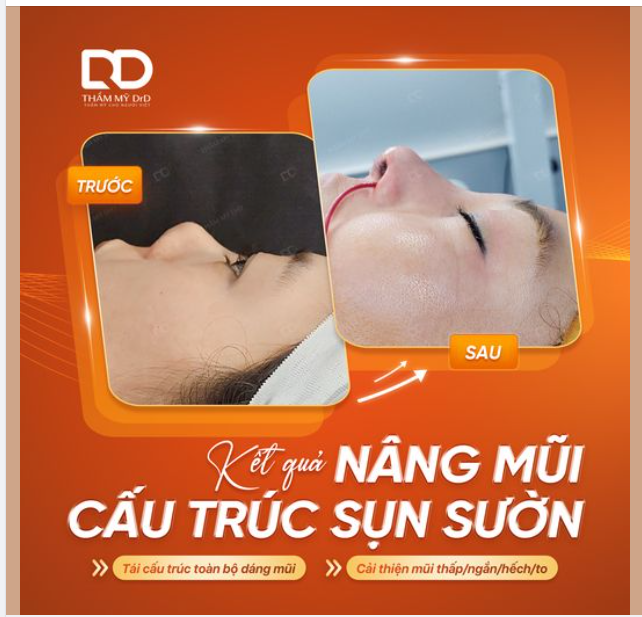 GÓC NGHIÊNG THAY ĐỔI 180 ĐỘ SAU NÂNG MŨI CẤU TRÚC SỤN SƯỜN