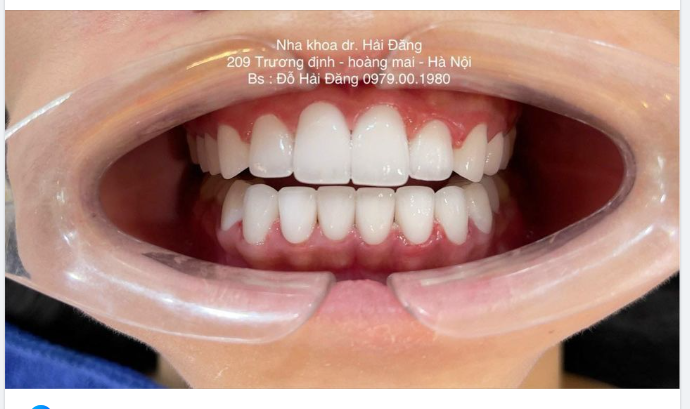 THẨM MỸ RĂNG SỨ - TÁI TẠO ĐƯỜNG CƯỜI ĐẸP TỰ NHIÊN