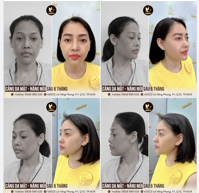 Khoe nhiều thì ngại, mà hổng khoe thì sao chị em biết được COMBO CĂNG DA MẶT + NÂNG MŨI SỤN SƯỜN SỬA LẠI nhà Dr. Hoạt đỉnh cao cỡ nào
