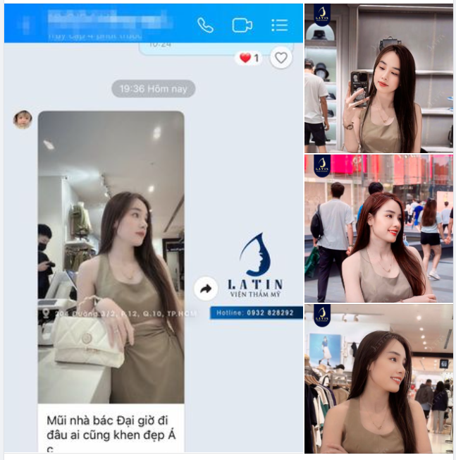 Nâng mũi xong ai gặp cũng khen đẹp