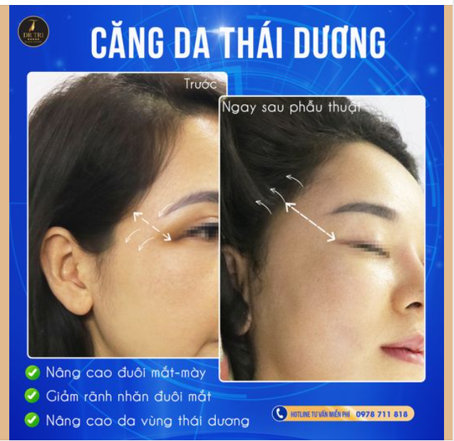 Hình ảnh Ngay sau phẫu thuật Căng Da Thái Dương
