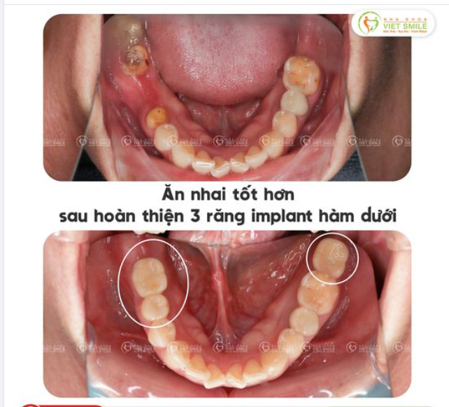 ĂN NHAI TỐT HƠN SAU HOÀN THIỆN 3 RĂNG IMPLANT HÀM DƯỚI