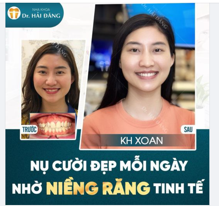 NỤ CƯỜI ĐẸP MỖI NGÀY NHỜ NIỀNG RĂNG TINH TẾ