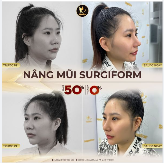 NÂNG MŨI CẤU TRÚC SỤN SURGIFORM – CHÂN ÁI CHO CÁC NÀNG THÍCH DÁNG MŨI TỰ NHIÊN