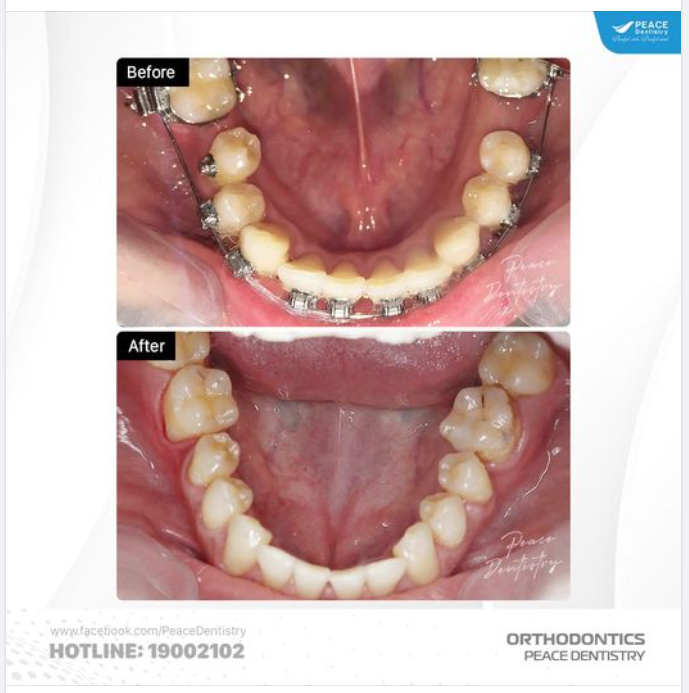 Ca lâm sàng  di gần đóng khoảng răng mất & Giải đáp các vấn đề về chỉnh nha đóng khoảng răng mất