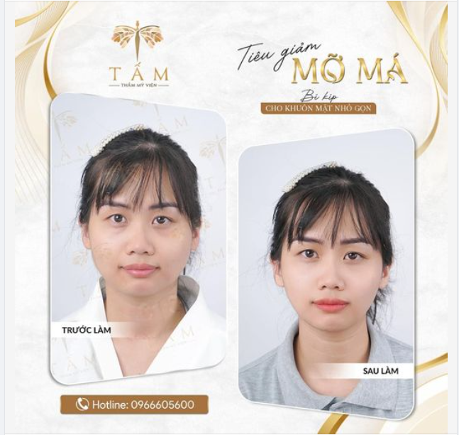 TẠM BIỆT MẶT BÁNH BAO CHỈ SAU 1 LẦN TIÊM