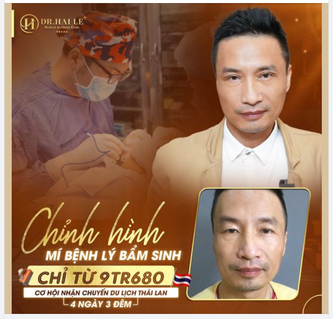 Dứt điểm sụp mí bẩm sinh cho khách hàng ánh mắt rạng ngời