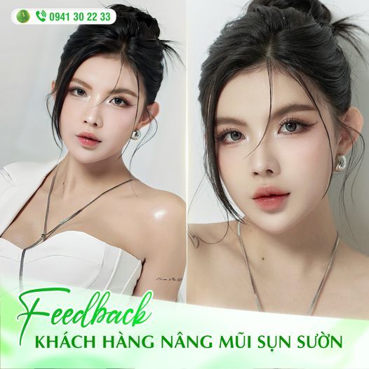 FEEDBACK CỦA CÔ NÀNG MỸ MỸ SAU 1 THÁNG NÂNG MŨI