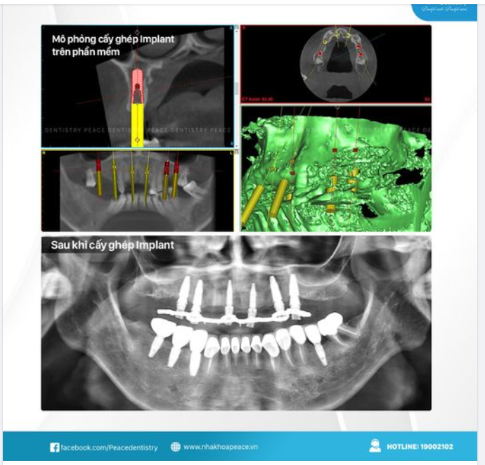 LẬP KẾ HOẠCH IMPLANT TRÊN PHẦN MỀM: