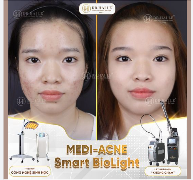 Mụn thâm Mụn trứng cá ​​​​​​​Mụn viêm gây khó chịu, mất tự tin, ảnh hưởng trực tiếp đến cuộc sống hàng ngày